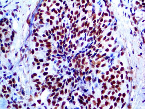 IHC of INI-1 on an FFPE Ewing’s Sarcoma Tissue